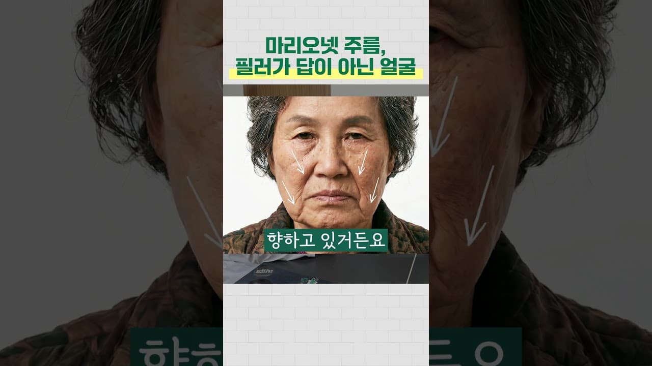 마리오넷 주름 필러가 답이 아닌 얼굴 | 마리오넷주름, 마리오넷주름해결방법, 울쎄라